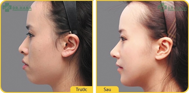 Hình ảnh trước và sau khi nâng mũi S-line của khách hàng
