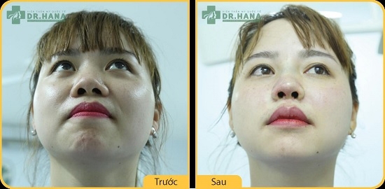 Hình ảnh trước và sau khi thu nhỏ cánh mũi không cần phẫu thuật bằng chỉ không tiêu Hoa Kỳ của khách hàng